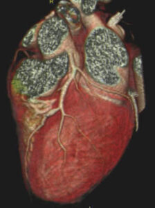 Cardiac CT scan