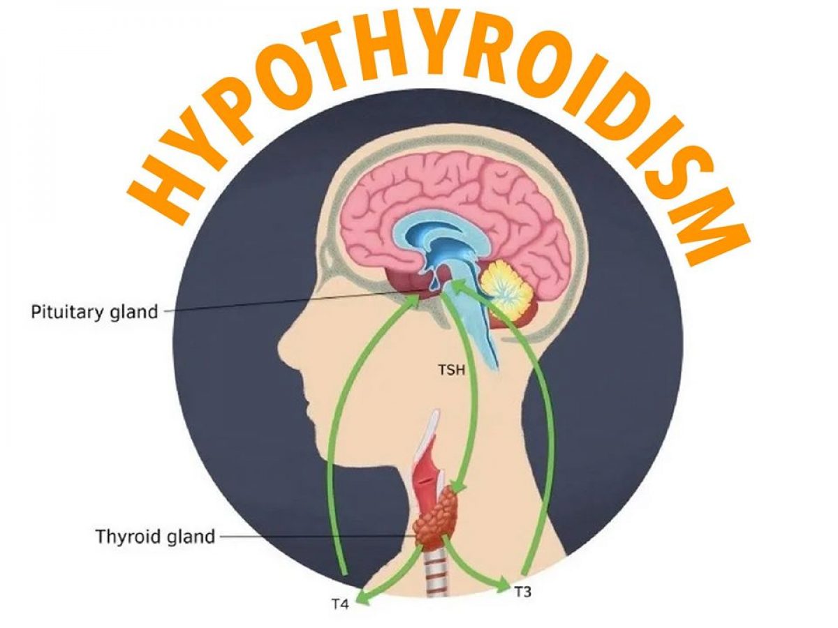 Symptoms and causes of hypothyroidism - Medrot.com