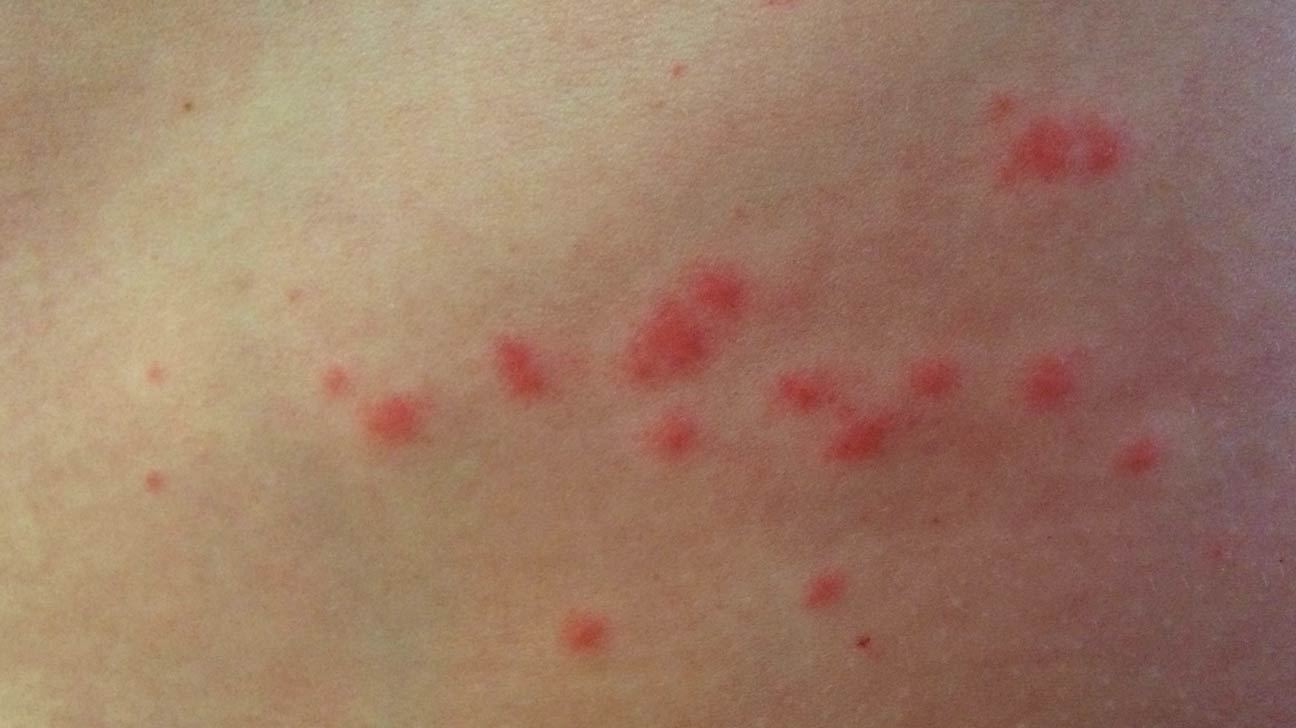 The 10 Most Common Summer Rashes and How to Avoid Them